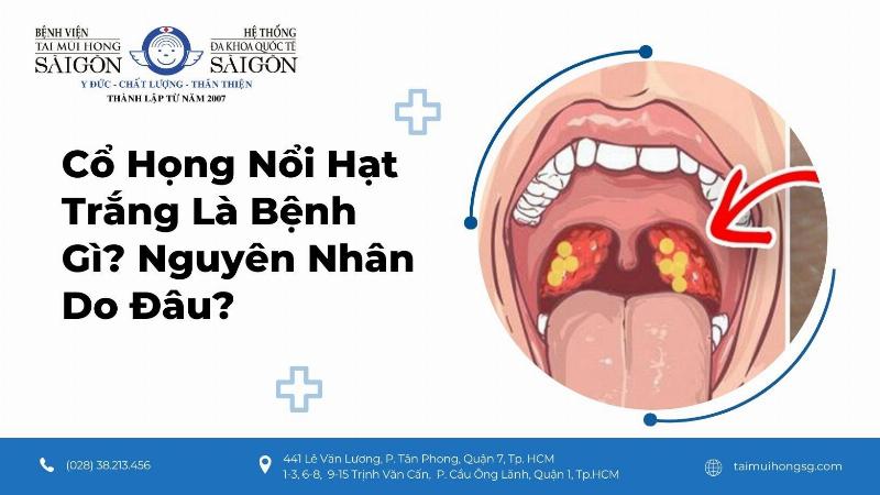 Thuốc điều trị viêm họng hạt trắng