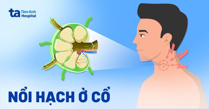 Các triệu chứng đi kèm nổi hạch ở cổ