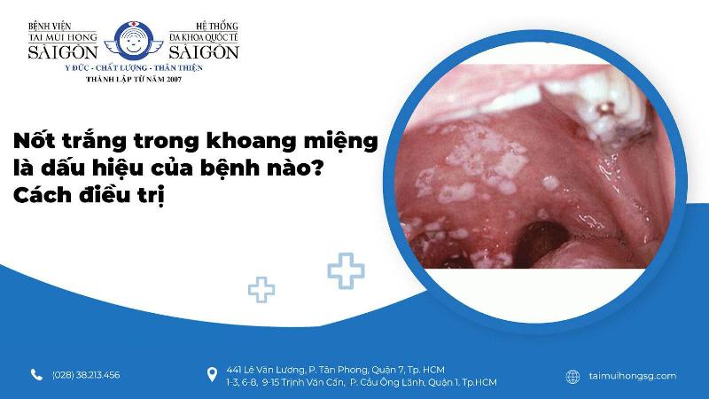 Chẩn đoán nổi mụn trắng trong miệng