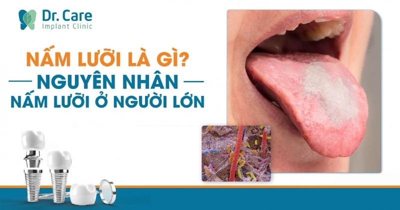 Điều trị nấm lưỡi ở người lớn