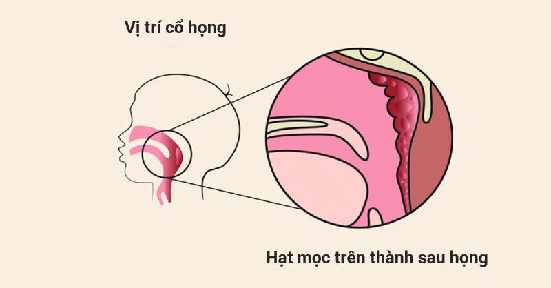 Điều trị viêm họng hạt bằng laser