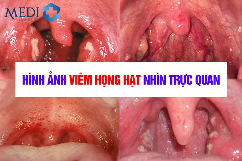 Hình ảnh viêm họng hạt do nhiễm trùng