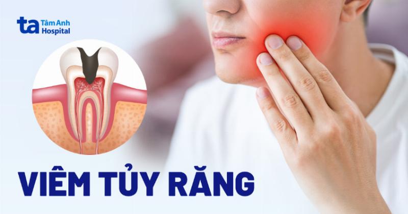 Viêm tủy răng gây đau nhức dữ dội