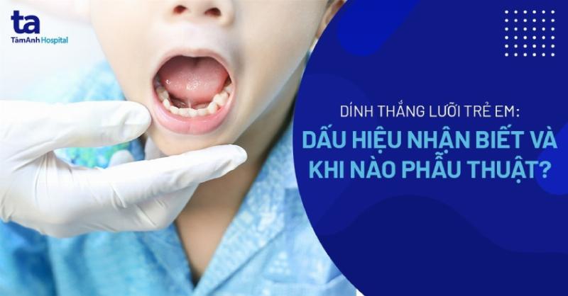 Phòng ngừa dính thắng lưỡi