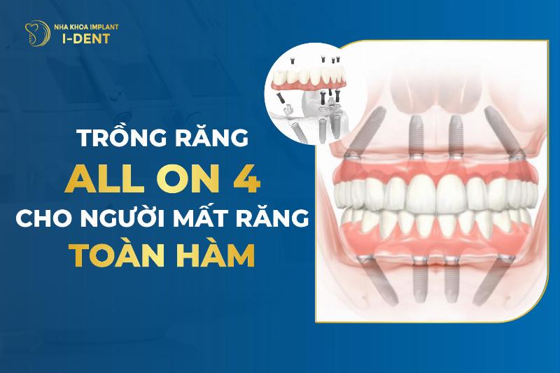 Hình ảnh minh họa những đối tượng phù hợp với phương pháp trồng răng All on 4