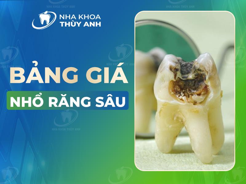 Bảng giá nhổ răng tham khảo