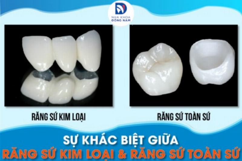 Bảng so sánh chi phí các phương pháp trồng răng giả