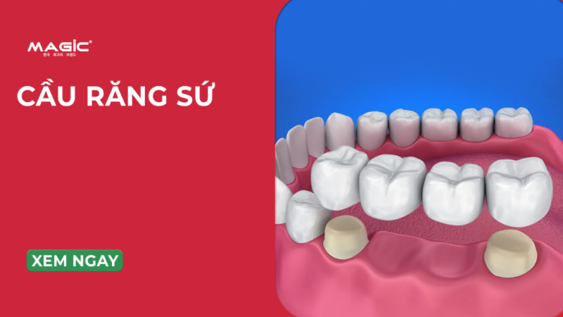 Cầu răng sứ: Phương pháp truyền thống, chi phí hợp lý