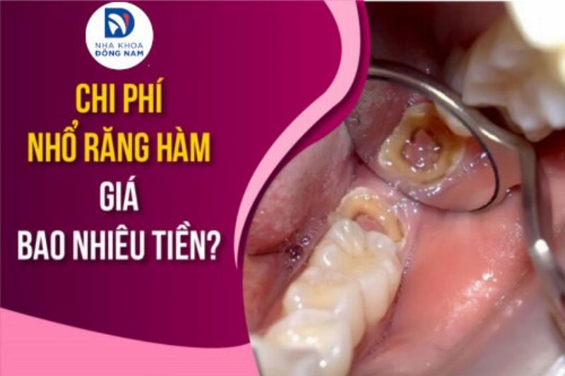 Chi phí nhổ răng hàm