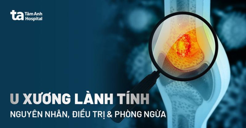 Đi khám bác sĩ khi có dấu hiệu u xương ác tính