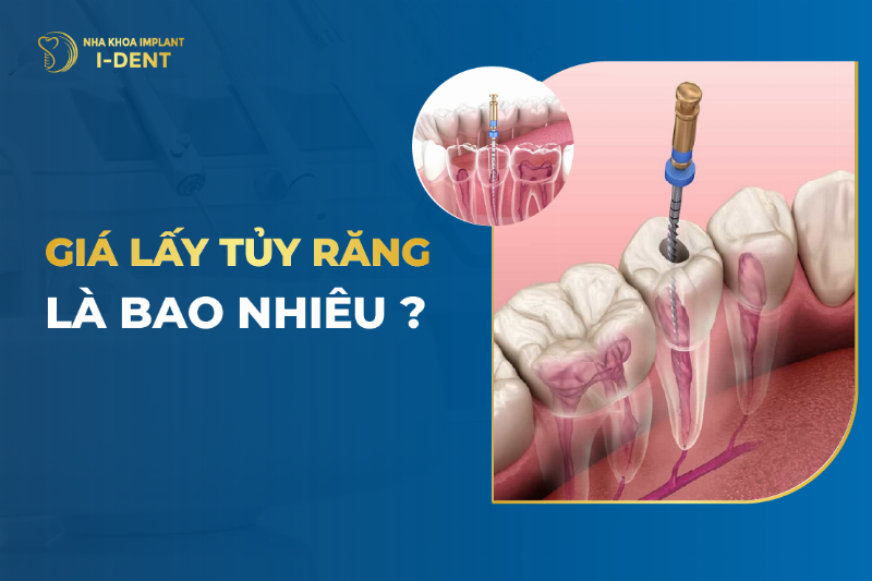 Điều trị tủy tại nha khoa