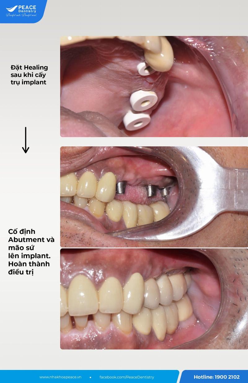 Ảnh minh họa gắn abutment và răng sứ