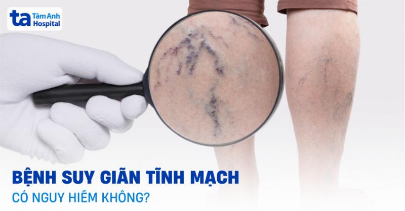 Các giai đoạn của giãn tĩnh mạch chi dưới