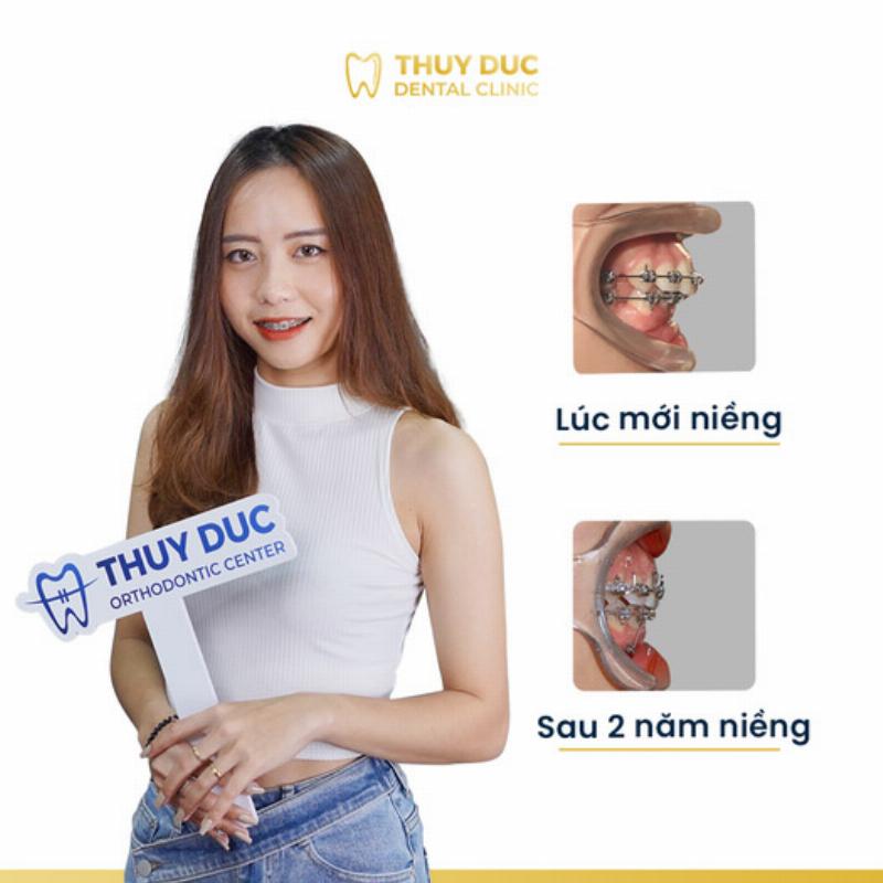 Hình ảnh răng trước sau niềng