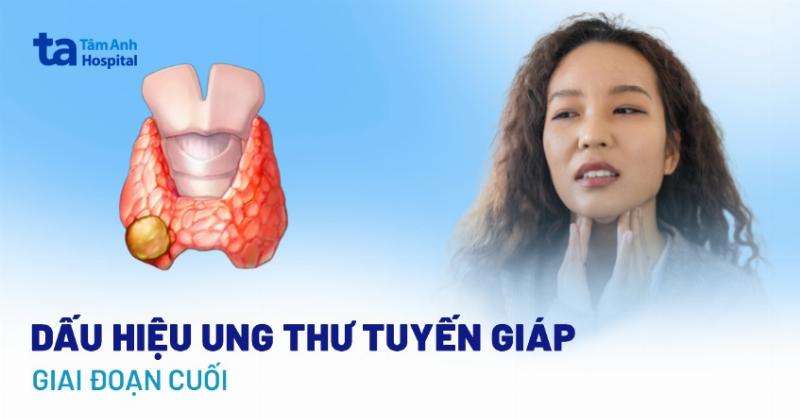 Ho dai dẳng do ung thư tuyến giáp