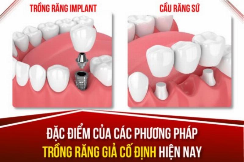 Hỏi đáp về trồng răng giả cố định