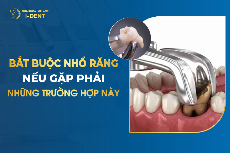 Khi nào cần nhổ răng?