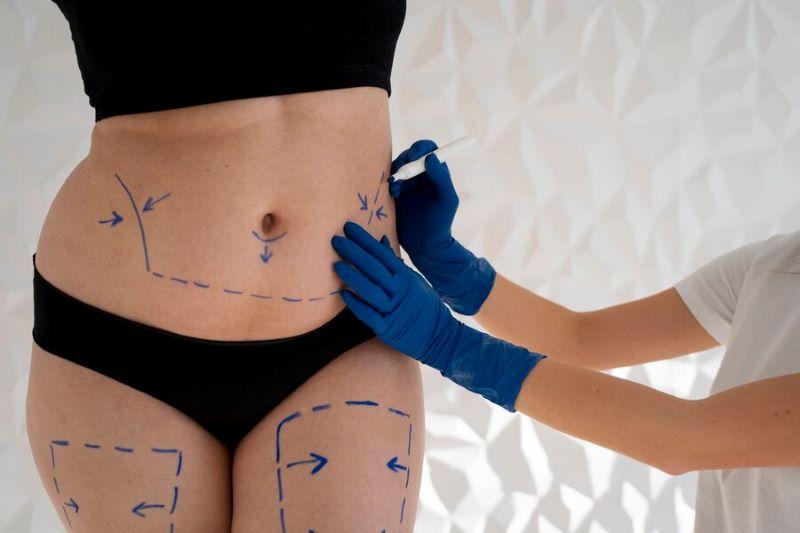 Hút mỡ bụng hết bao nhiêu tiền: Chi phí và những điều cần biết