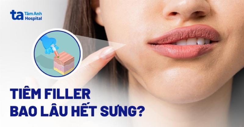 Mẹo và biến tấu khi tiêm filler má