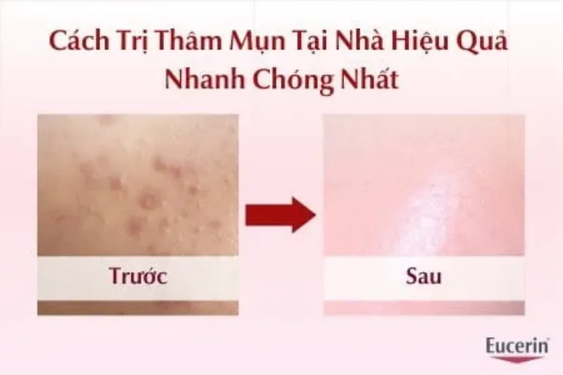 Ngăn Ngừa Thâm Mụn