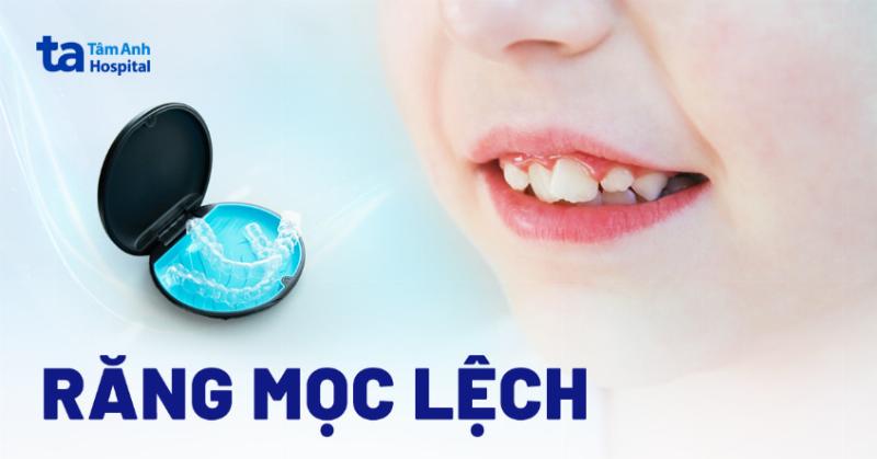 Hiểu Rõ Về Răng Mọc Lệch Hàm Dưới