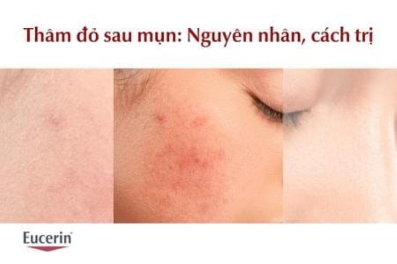 Nguyên Nhân Thâm Đỏ Sau Nặn Mụn