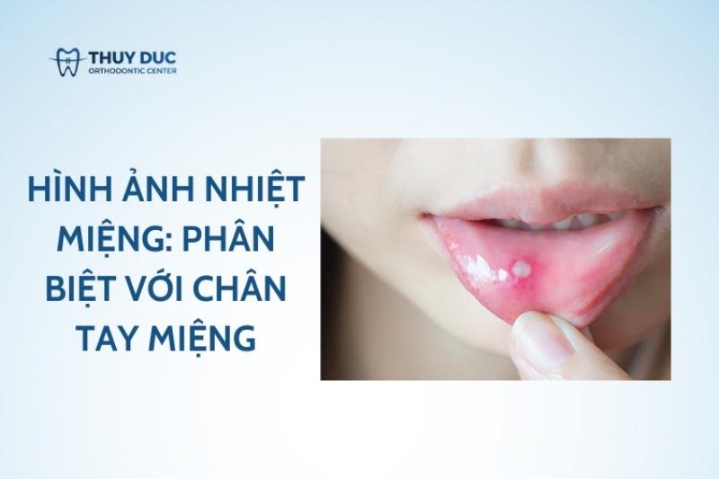 Hình ảnh nhiệt miệng ở trẻ em