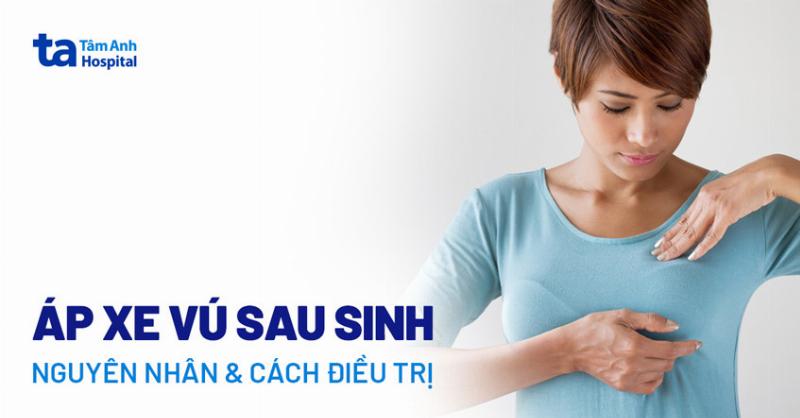 Phòng ngừa áp xe ngực sau sinh