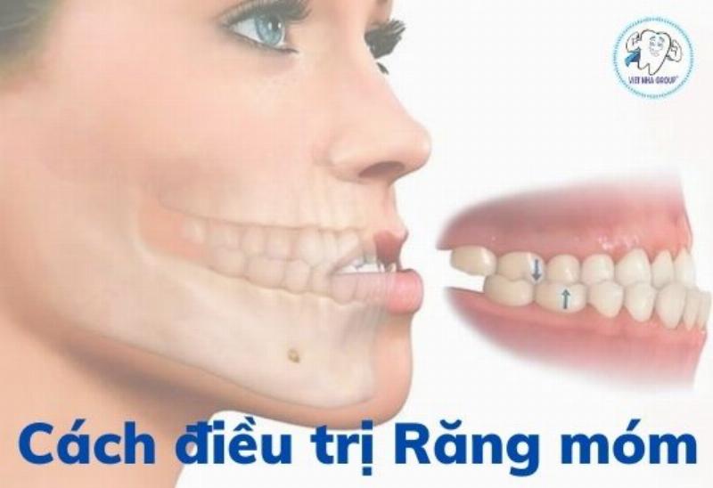 Cách Trị Móm Tại Nhà: Sự Thật Bạn Cần Biết