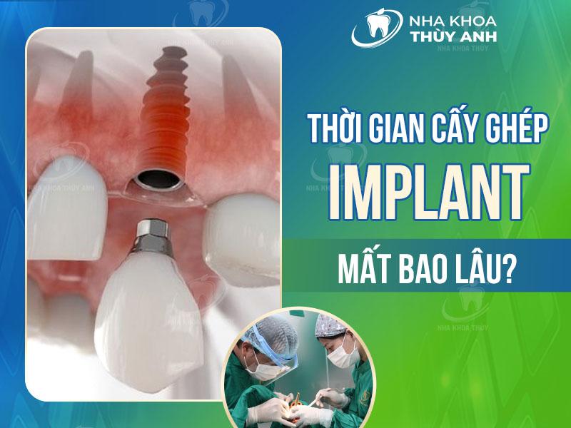 Thời gian trồng răng implant phụ thuộc vào nhiều yếu tố