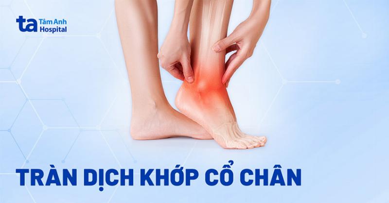 Tràn Dịch Khớp Cổ Chân: Nguyên Nhân, Triệu Chứng và Cách Điều Trị