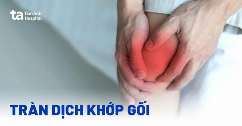 Điều Trị Tràn Dịch Khớp Gối: Giải Pháp Hiệu Quả Cho Bạn