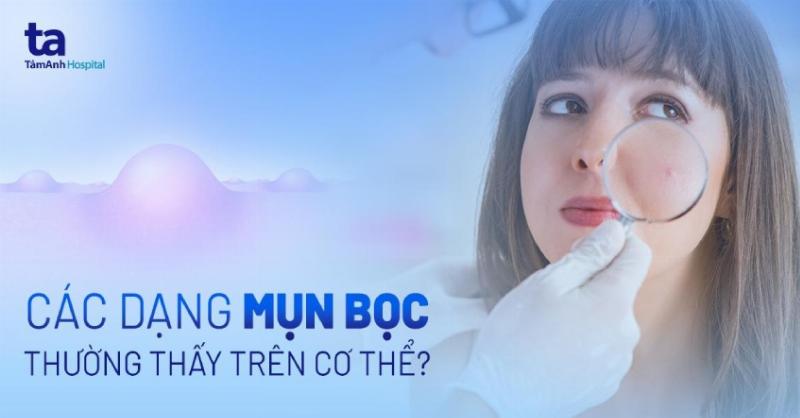 Bị Mụn Bọc Nên Làm Gì? Hướng Dẫn Chăm Sóc Da Hiệu Quả