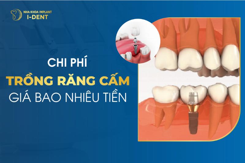 Phương pháp trồng răng cấm