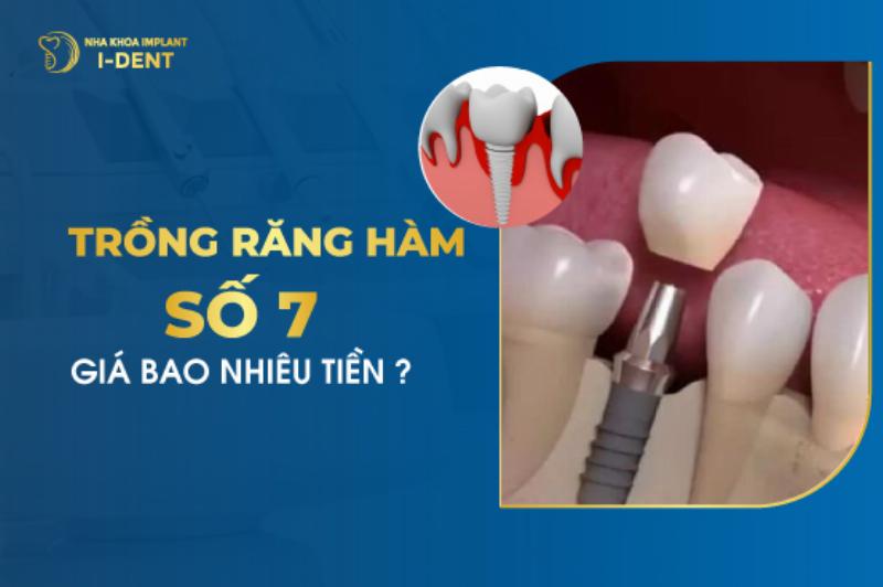 Bảng giá tham khảo trồng răng hàm số 7