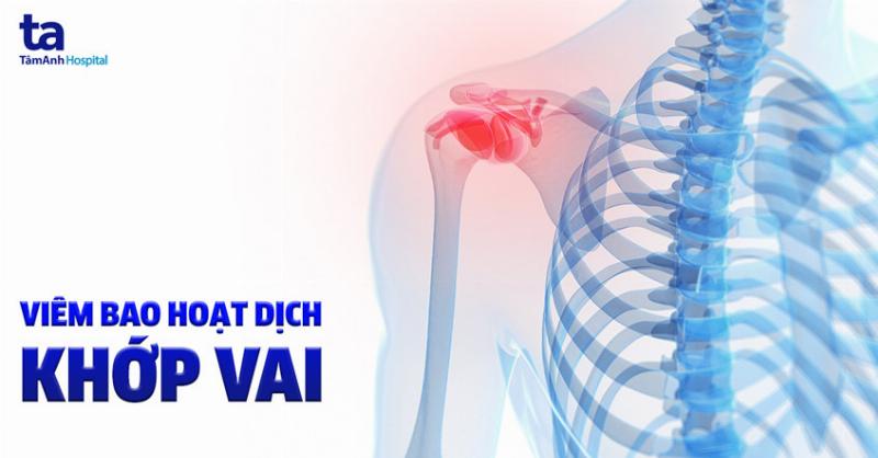 Viêm bao hoạt dịch khớp vai: Nguyên nhân và triệu chứng