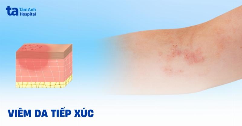 Phòng ngừa viêm da tiếp xúc dị ứng ở mặt