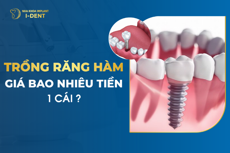 Bác sĩ tư vấn chi phí trồng răng hàm