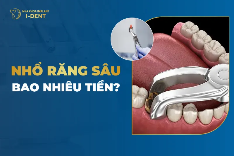 Bảng giá tham khảo nhổ răng tại Nha Khoa Bảo Anh