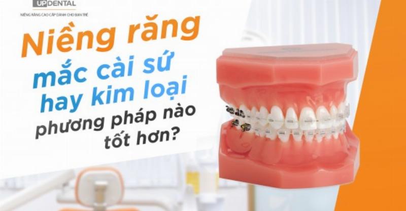 Các loại niềng răng: mắc cài kim loại, mắc cài sứ, niềng răng trong suốt.