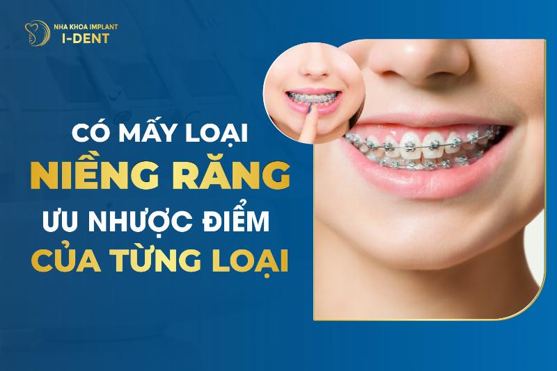 Các loại niềng răng phổ biến