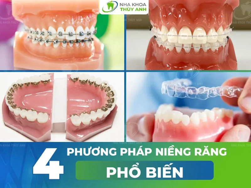 Các Phương Pháp Niềng Răng Phổ Biến