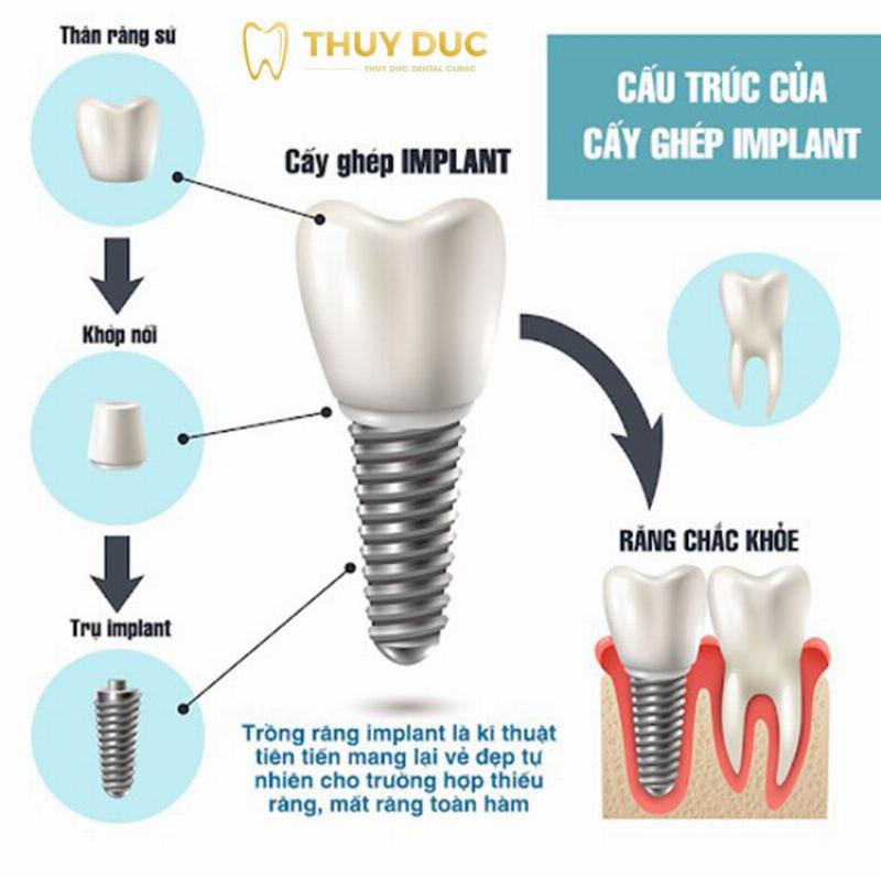 Các yếu tố ảnh hưởng đến chi phí trồng răng