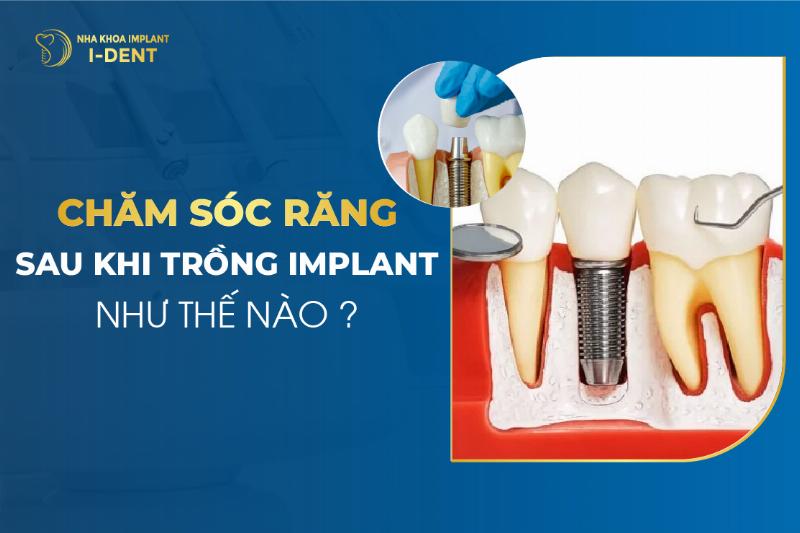 Chăm sóc răng miệng sau khi trồng răng