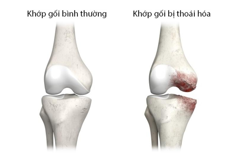 Cách Chữa Tràn Dịch Khớp Gối Tại Nhà: Phương Pháp An Toàn & Hiệu Quả