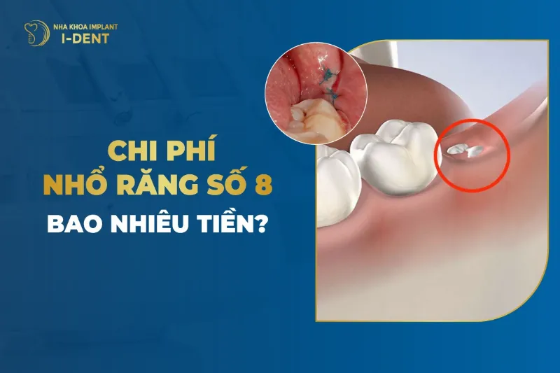 Chi phí nhổ răng phụ thuộc vào tình trạng răng miệng