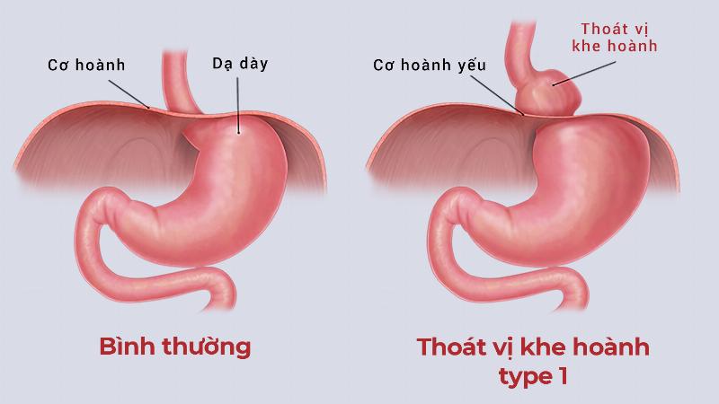 Hình ảnh minh họa cơ hoành