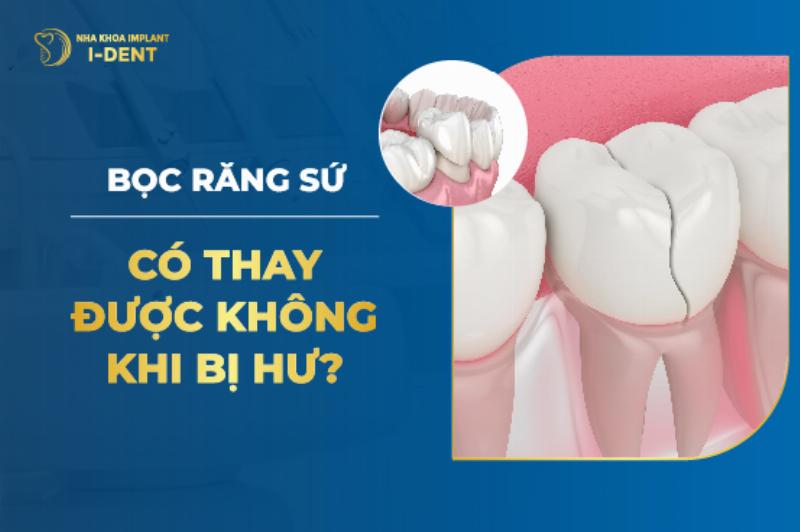 Trồng răng sứ giá bao nhiêu 1 chiếc?