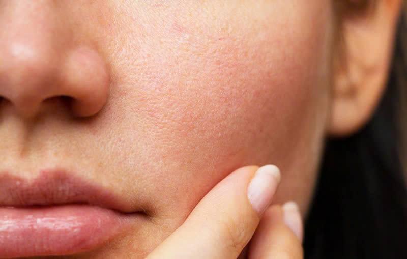 Có Nên Peel Da Khi Bị Mụn Không?