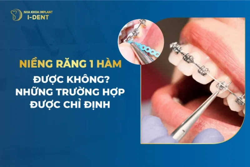 Niềng Răng 1 Hàm Có Được Không? Lợi Ích và Lưu Ý